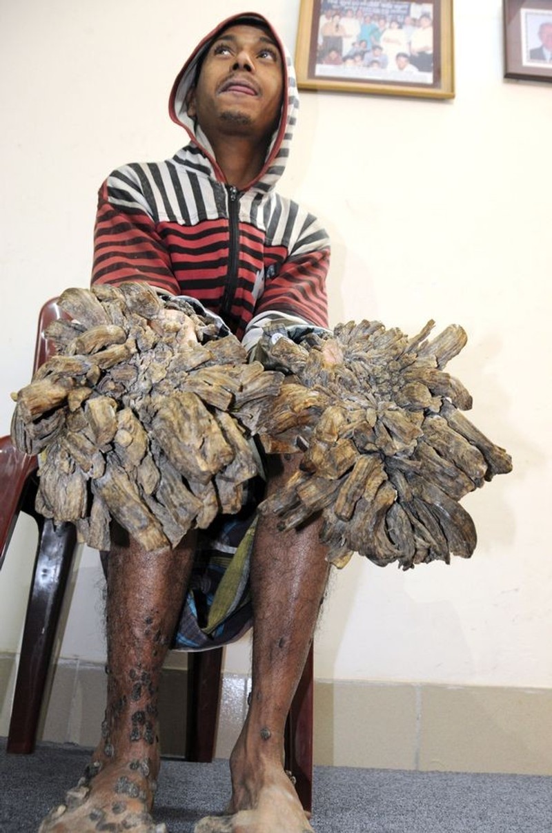 'The pain is unbearable': viral 'tree man' with extremely rare disease had  his dream come true. But much worse was to come | South China Morning Post, image size:800x1206