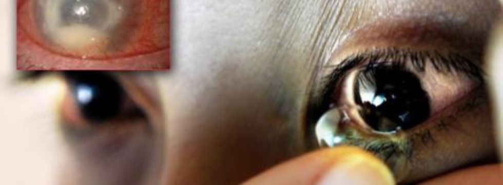 acanthamoebakeratitis c