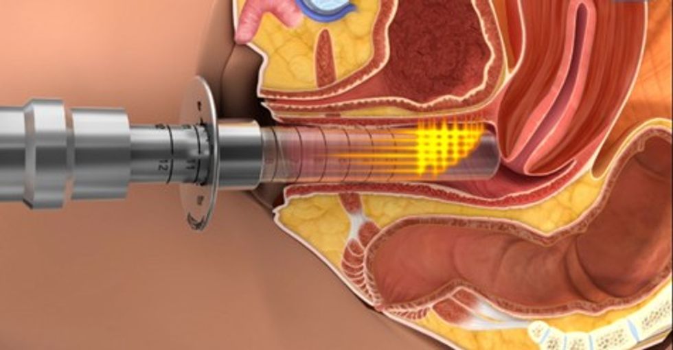 Accion GYNELASE en mucosa vaginal