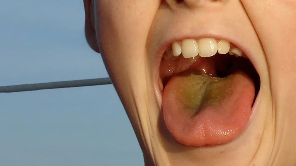 acid reflux tongue slide4