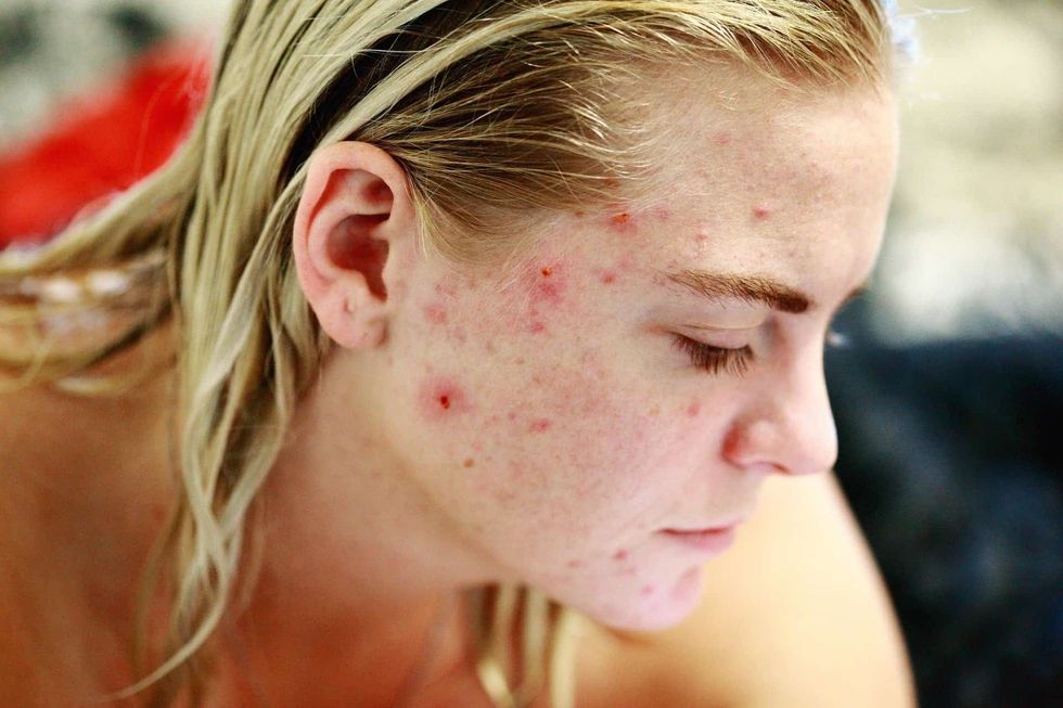 acne struggle