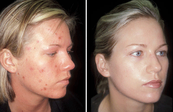 Acne Vulgaris Cystic 1 0604