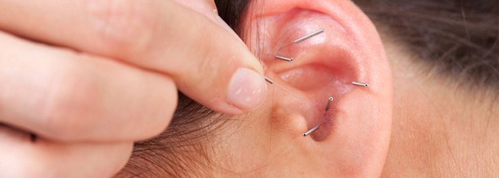 acupuncture tinnitus