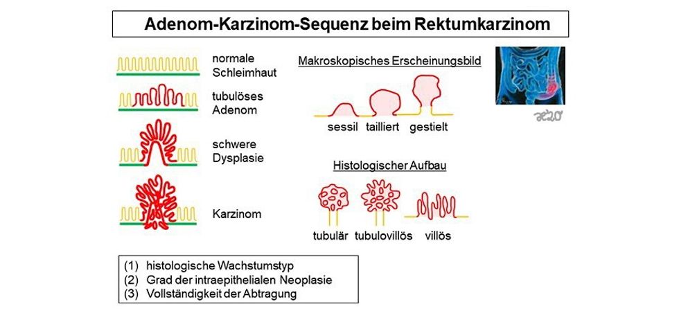 adenom karzinom