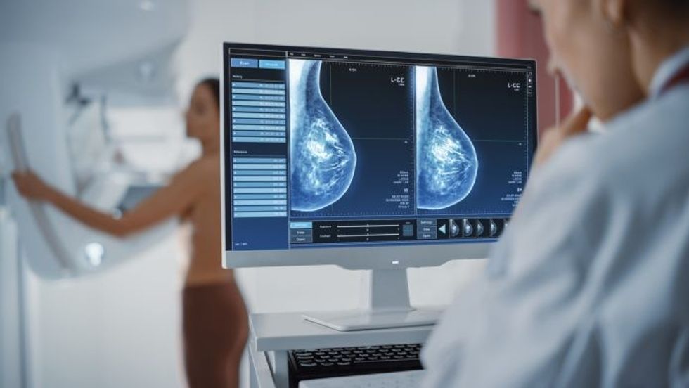AI breast cancer screening 1
