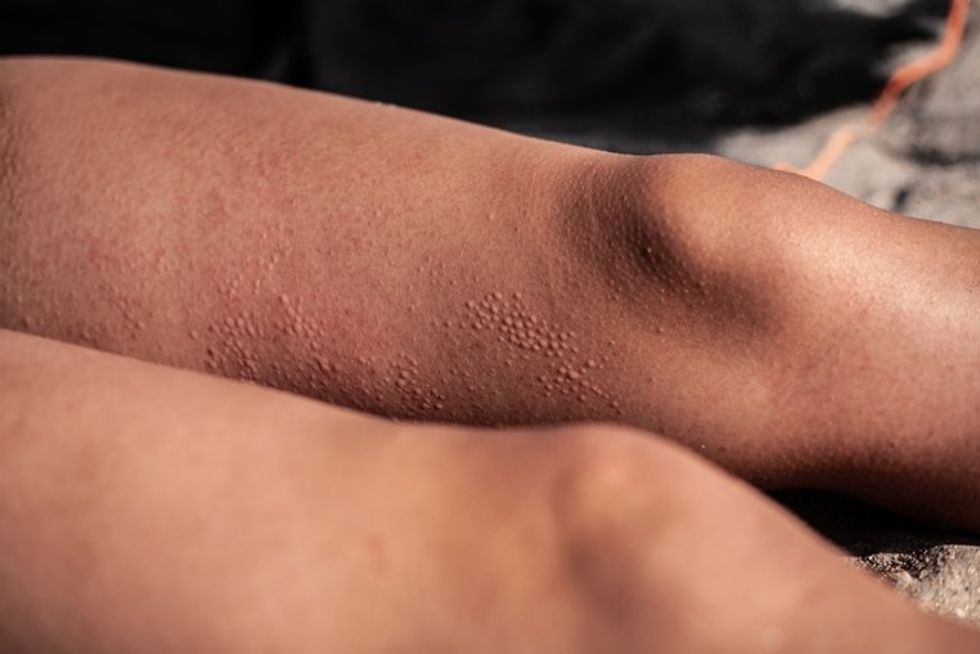 alergia ao calor 40089 l