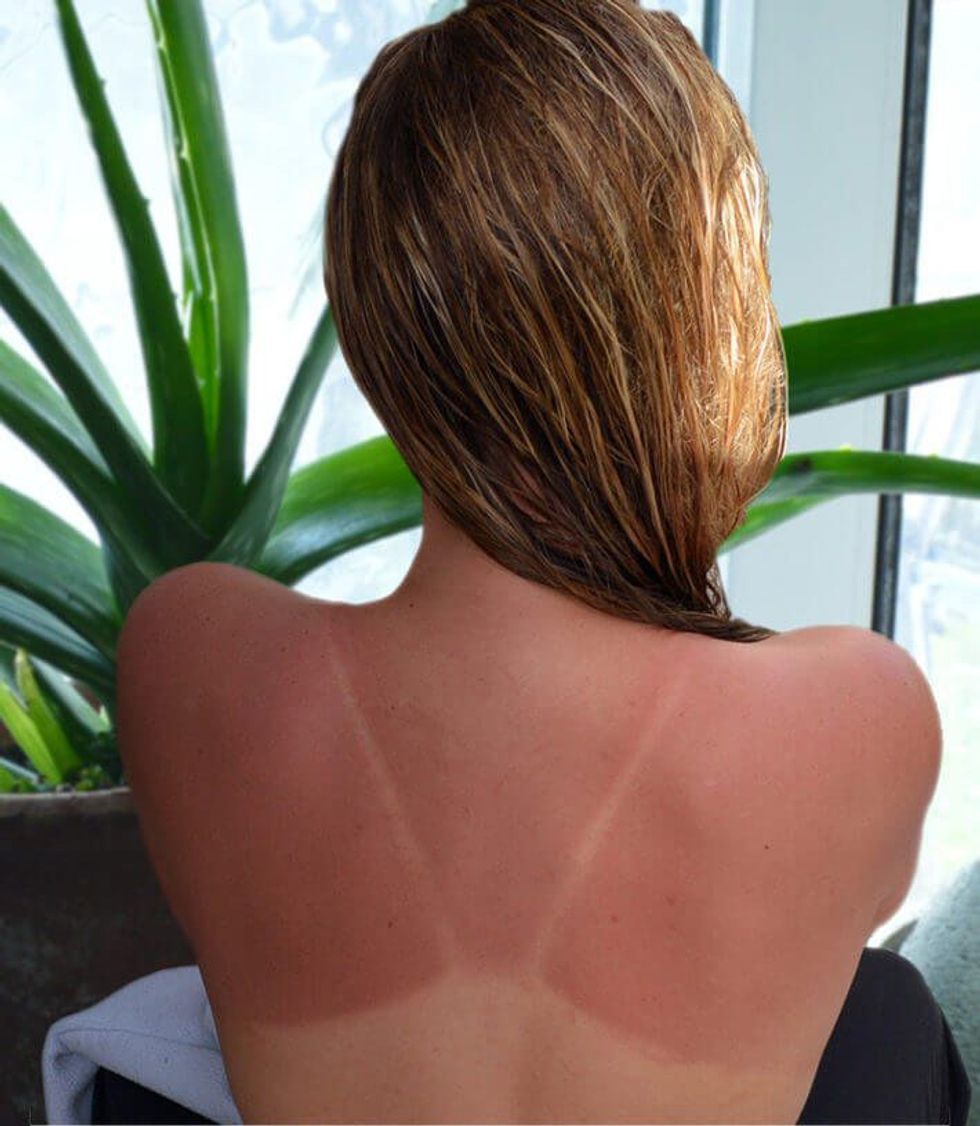aloe vera sunburn