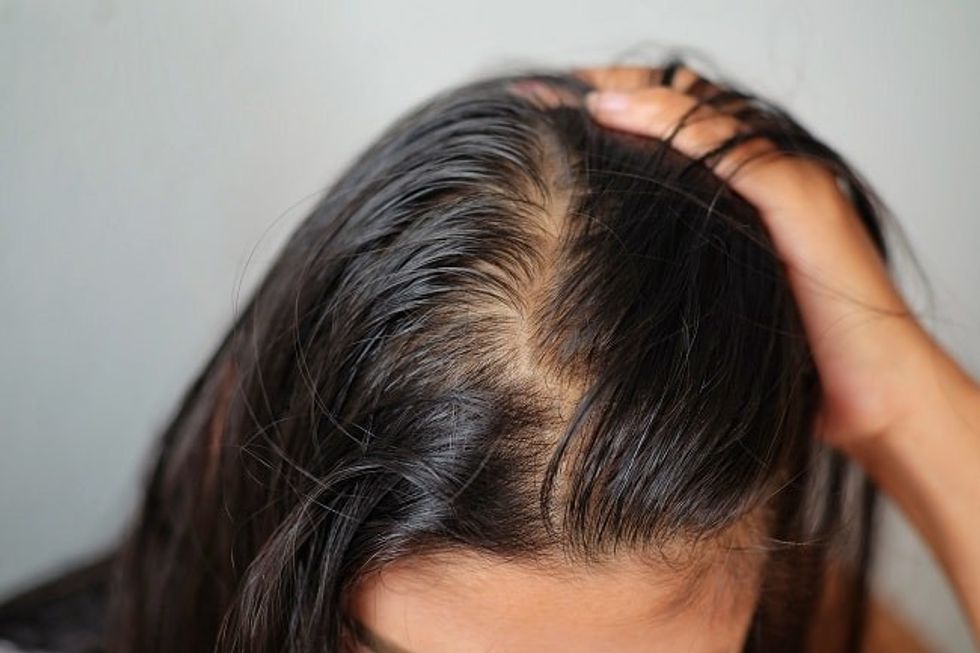alopecia androgenetik wanita