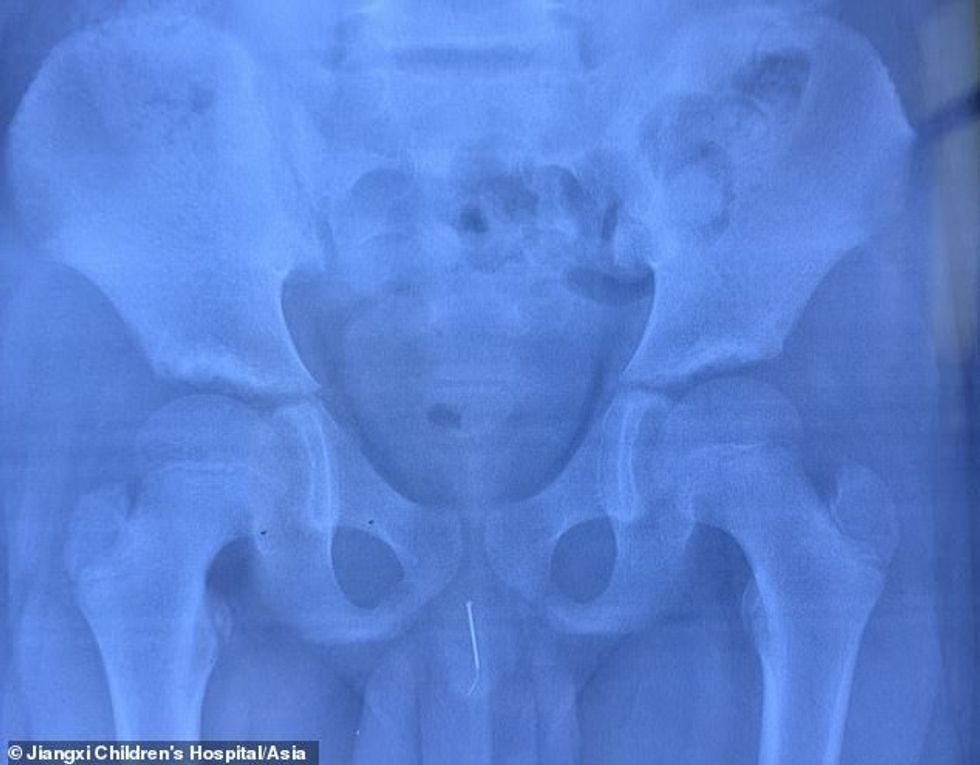 An X-ray photo shows the needle that was inserted from the urethra by a boy in Nanchang, China, undated. The needle was removed at Jiangxi Children's Hospital