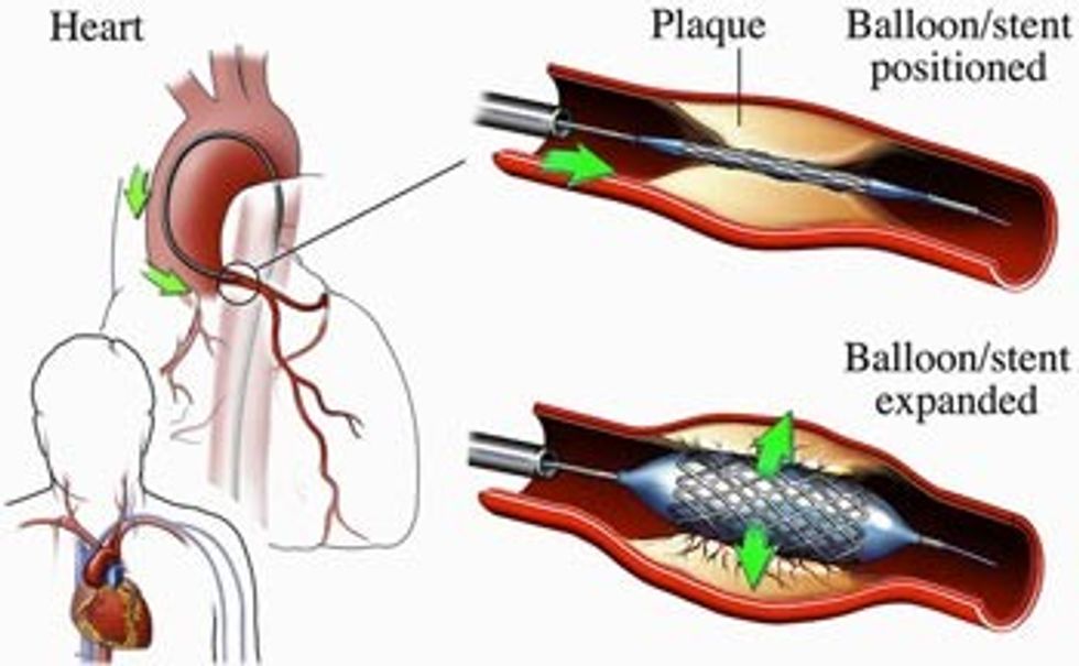 Angioplastika koronare