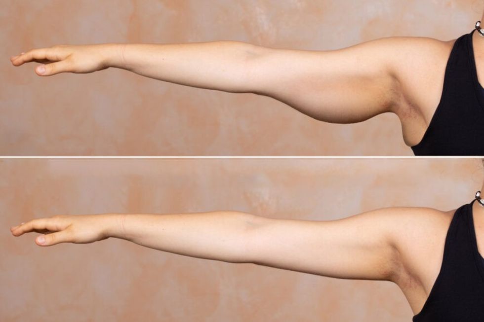 Arm Fat Questions Answers 1