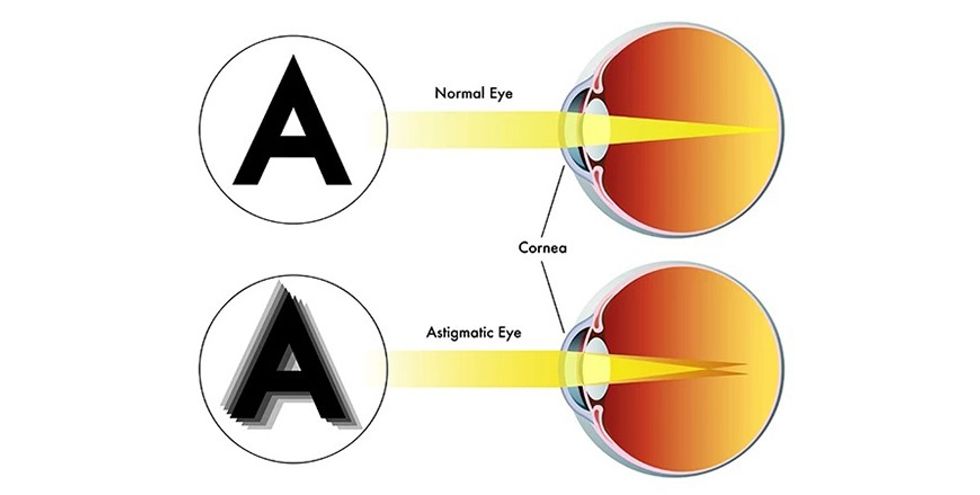 astigmatic eye