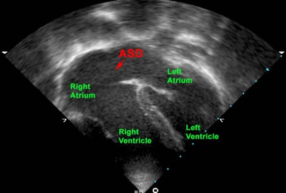 atrial septal defect diagnosis kkh