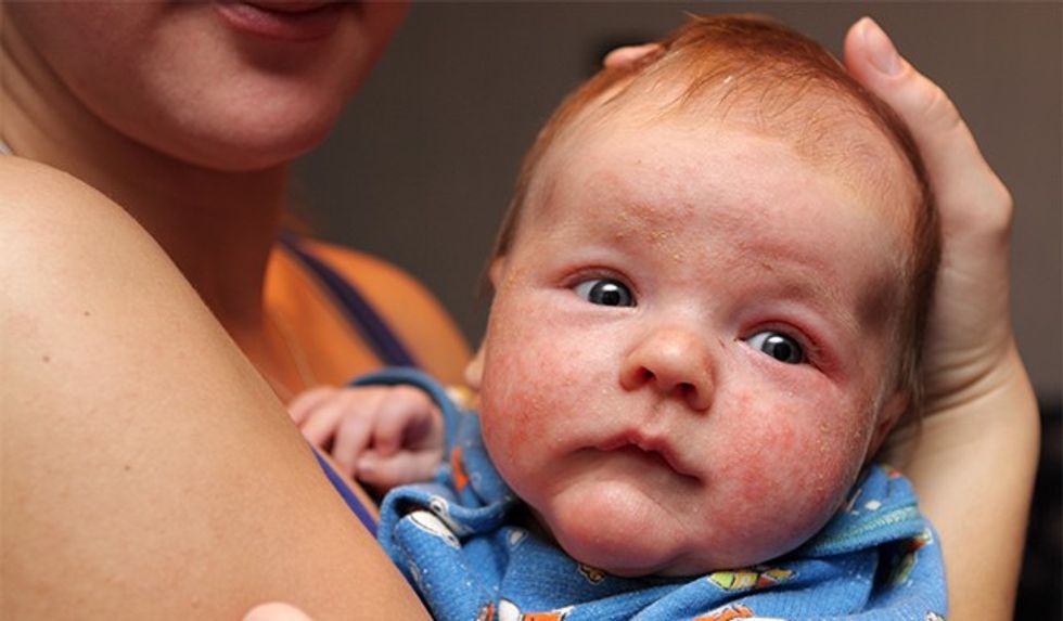 Baby has eczema on his face