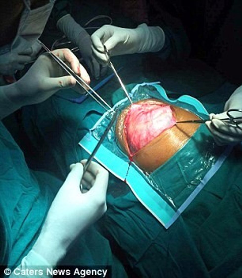 Bebes me bark të fryrë që nuk mund të ushqehej i nxoren diçka te pazakonte foto 3