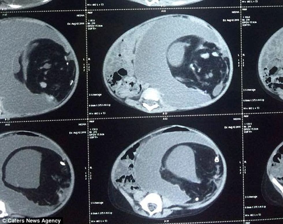 Bebes me bark të fryrë që nuk mund të ushqehej i nxoren diçka te pazakonte foto 5