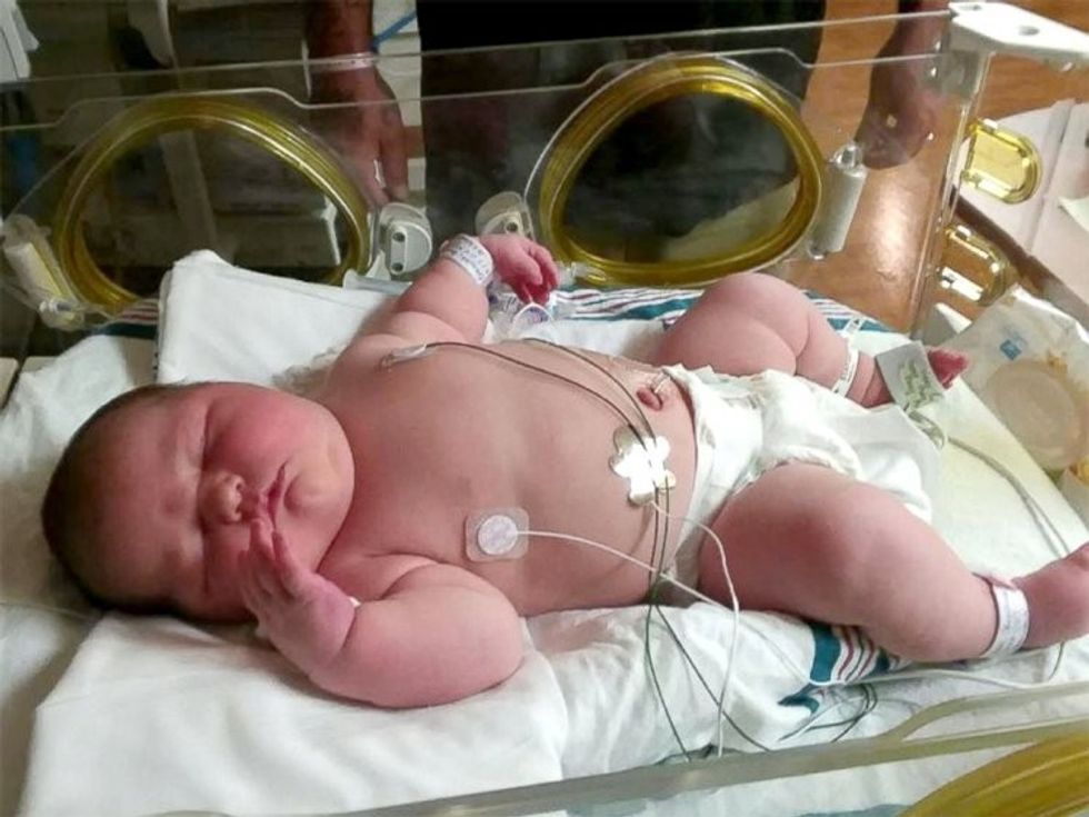 Bebja me peshë të lartë qe tani duket si femije i vogel foto 2