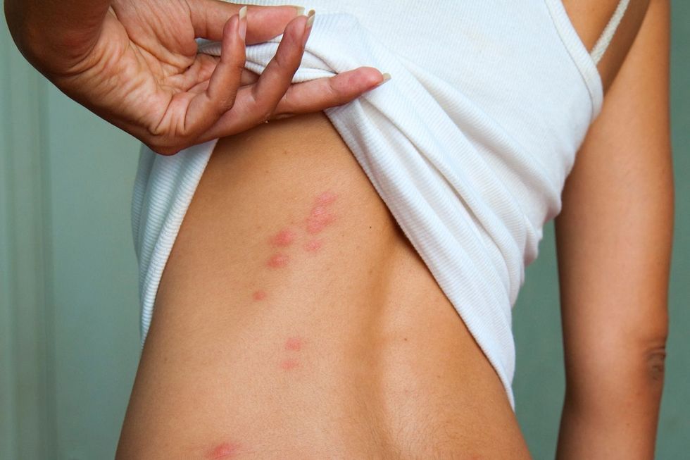 Bedbug bites 595135b63df78cae814a89bd