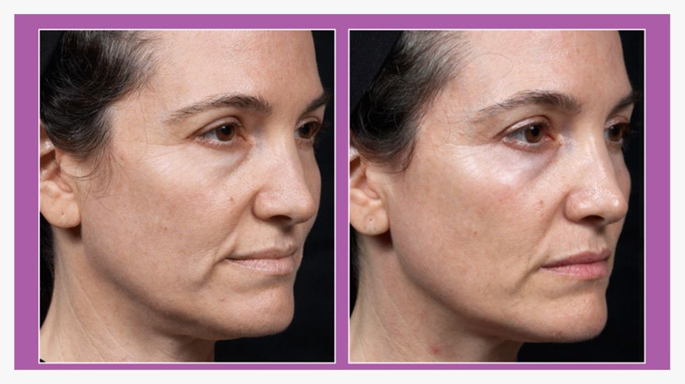 Before and after radiofrequency therapy on the face slide1