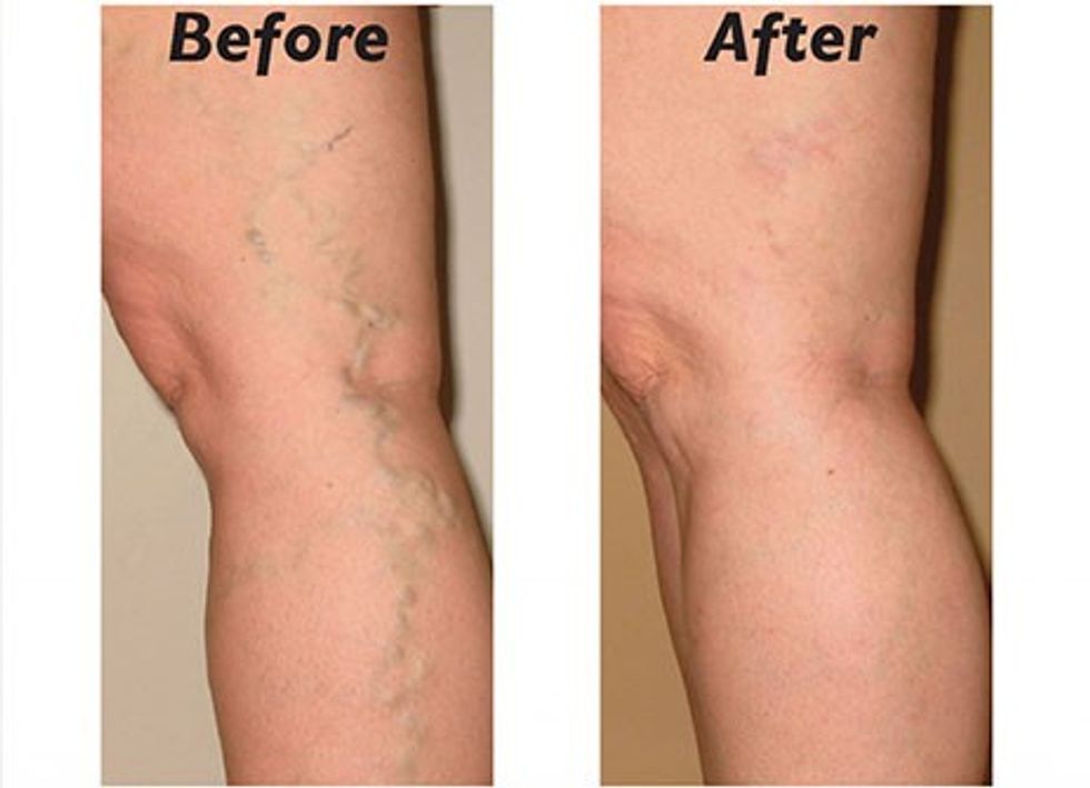 beforeafter