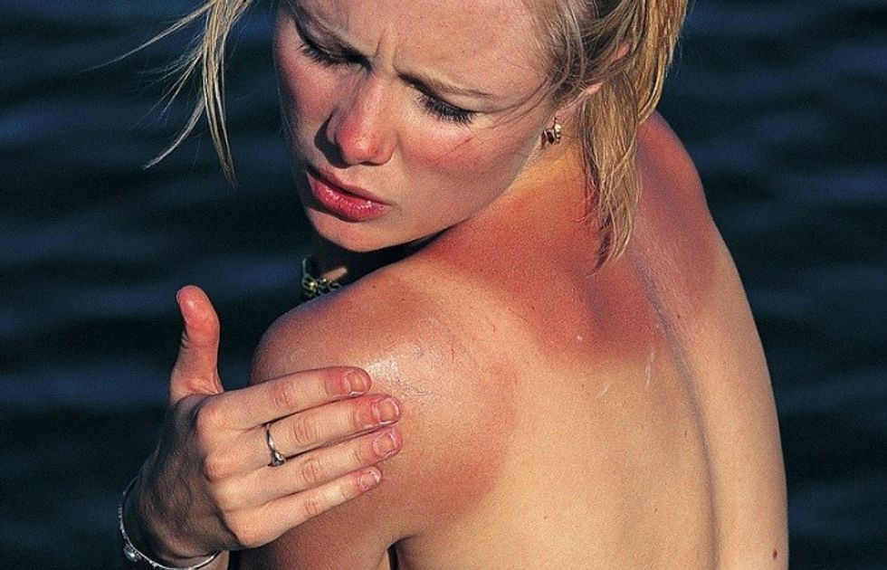 best lotion for sunburn