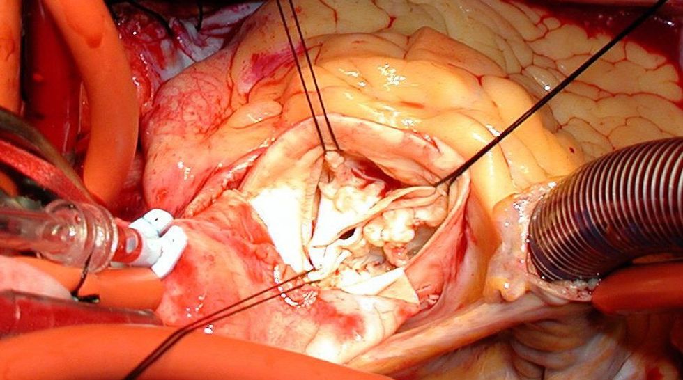 BicuspidAorticValveLARG8