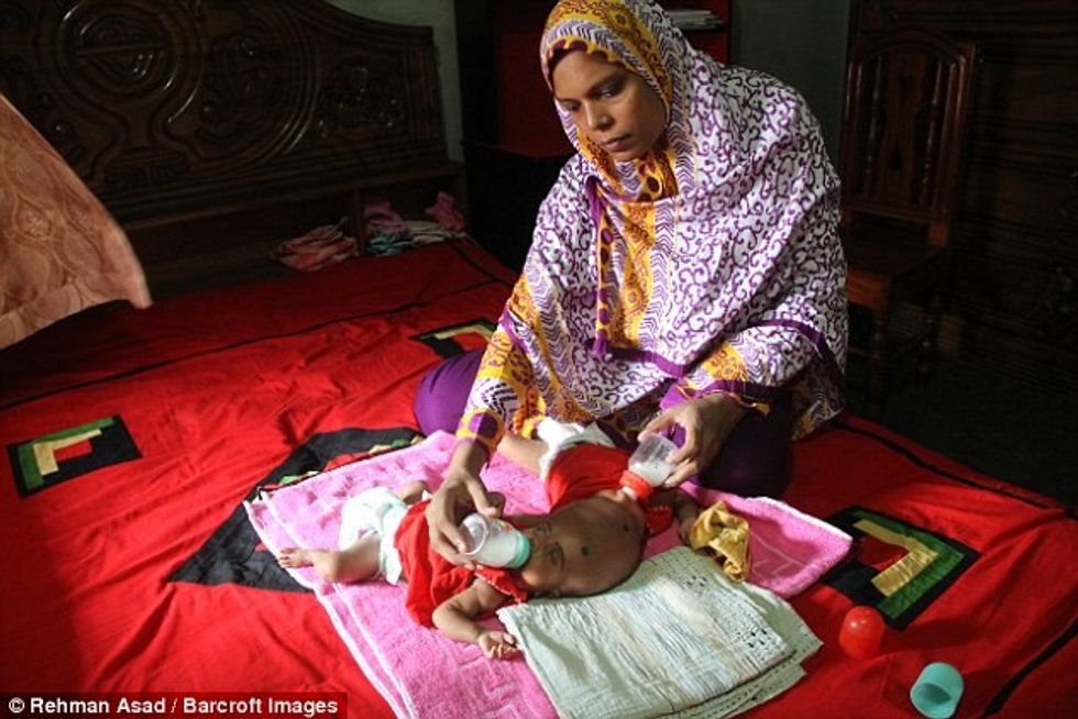 Binjaket e lindura me koka të ngjitura ende nuk mund ti nenshtrohen operimit foto 4