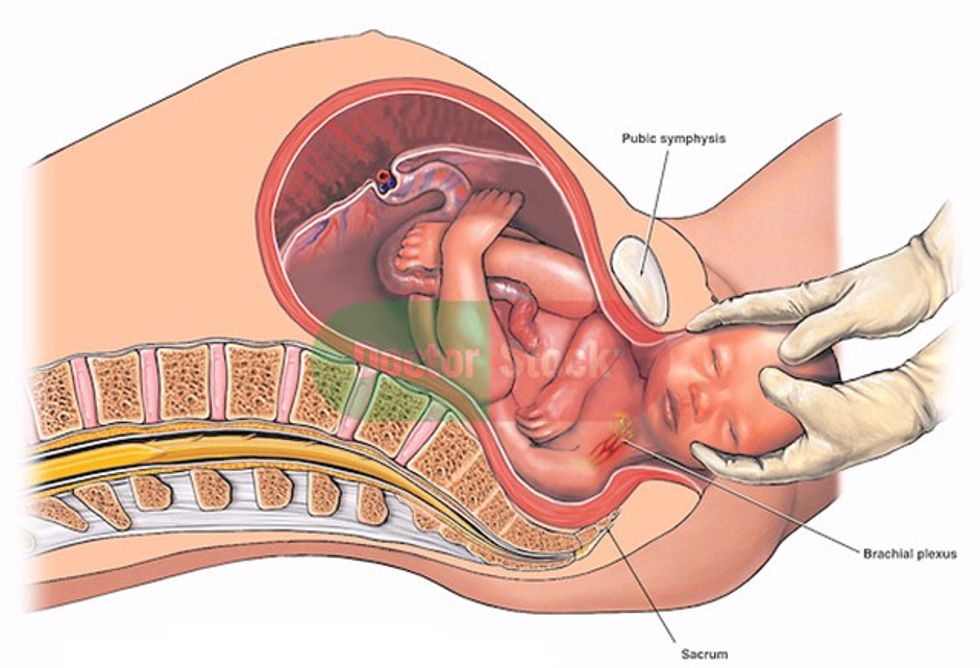 Birth Injury - Shoulder Dystocia with Brachial Plexus Injury. This medical exhibit pictures a lesser known cause of shoulder dystocia, or brachial plexus injury, during normal vaginal delivery. In this case, the baby's left shoulder is caught behind the mother's sacrum instead of the typical shoulder dystocia injury caused by the mother's pubic symphysis (pubic bone). The baby is facing the viewer in this illustration.