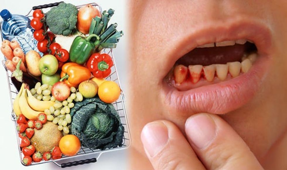 Bleeding gums could be a sign of a vitamin C deficiency 953723