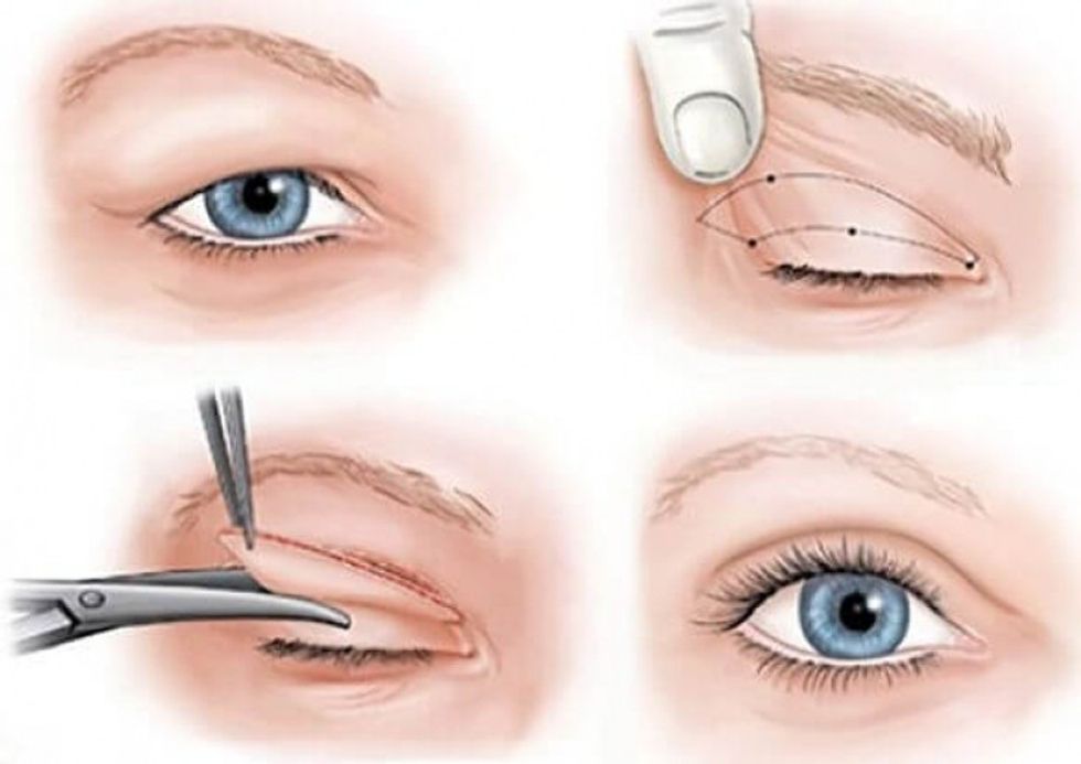 Blefaroplastika Slika