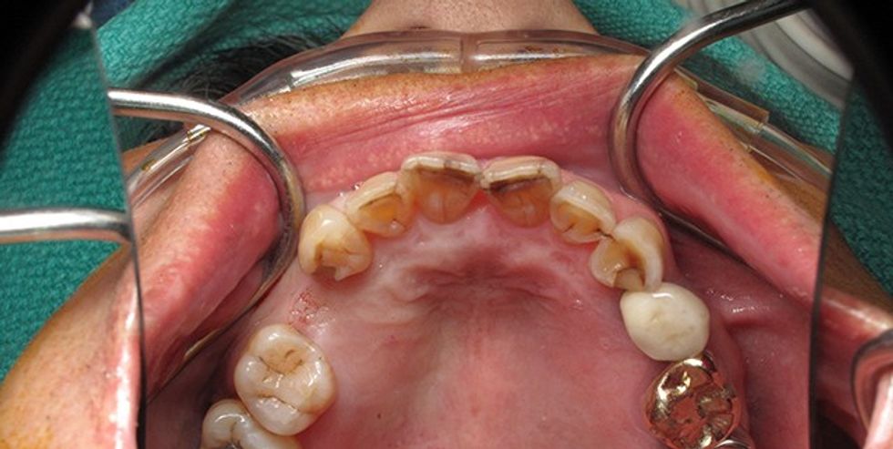 block-bone-graft-ramsey-amin-dds-front-tooth-8