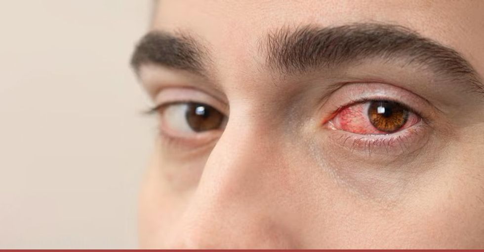 bloodshot red blood eye male 1 1