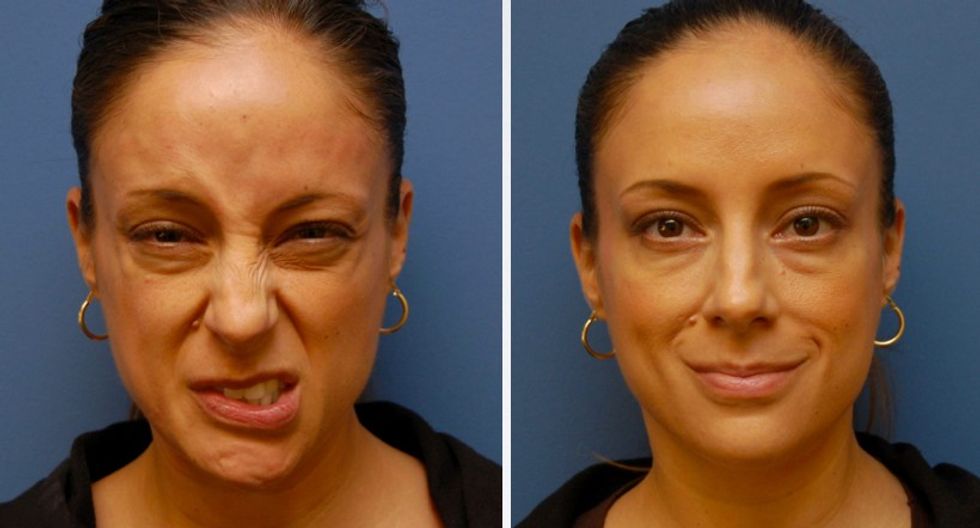 Botox.Synkinesis.BellsPalsy.FacialParalysis