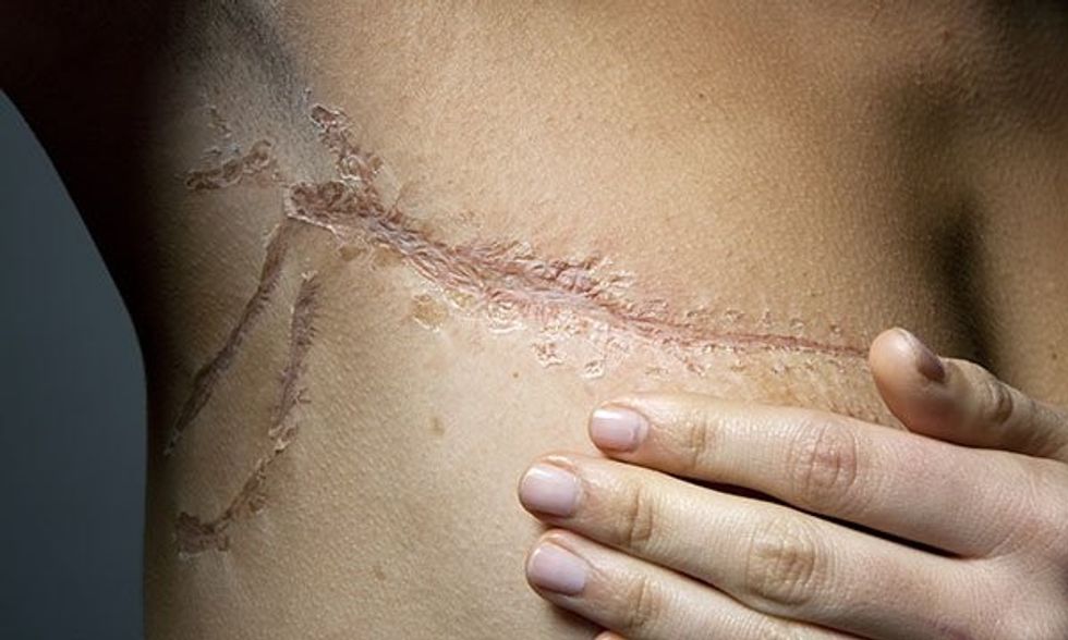 Breast cancer surgery scar SPL 0