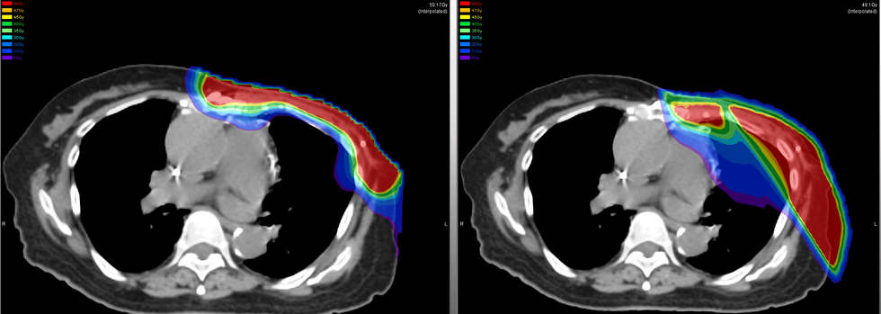 Breast screenshot for Amy