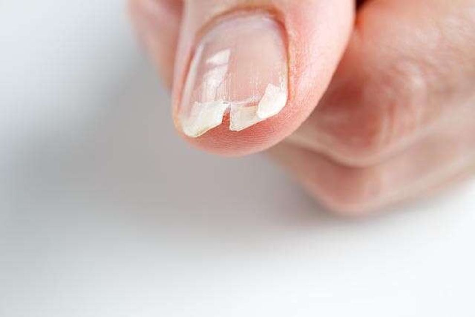 brittle nails causes symptoms treatment and home remedies
