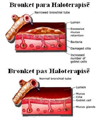 Bronket para dhe mbas HT(1)