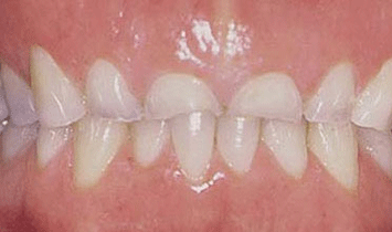 bruxism
