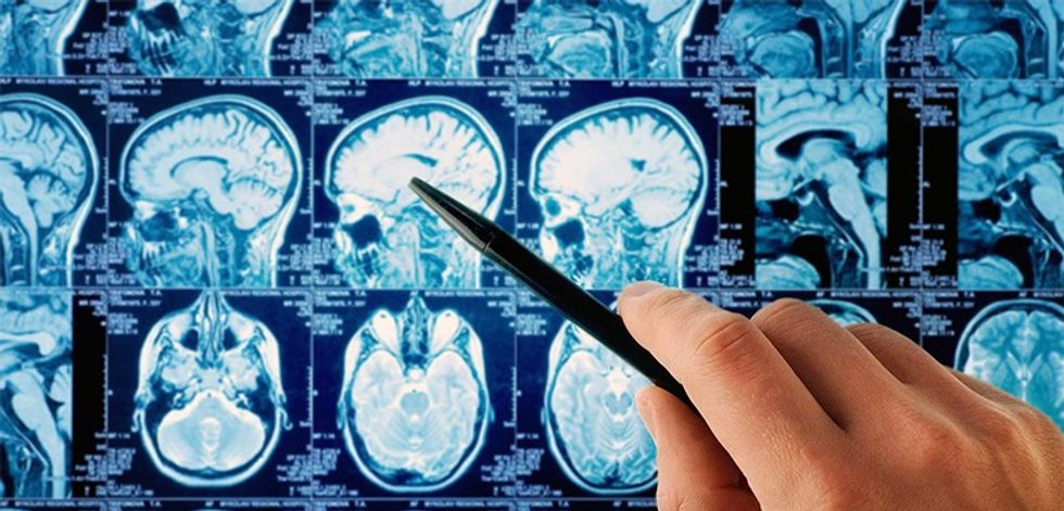 Can cell phones cause brain cancer We asked the experts