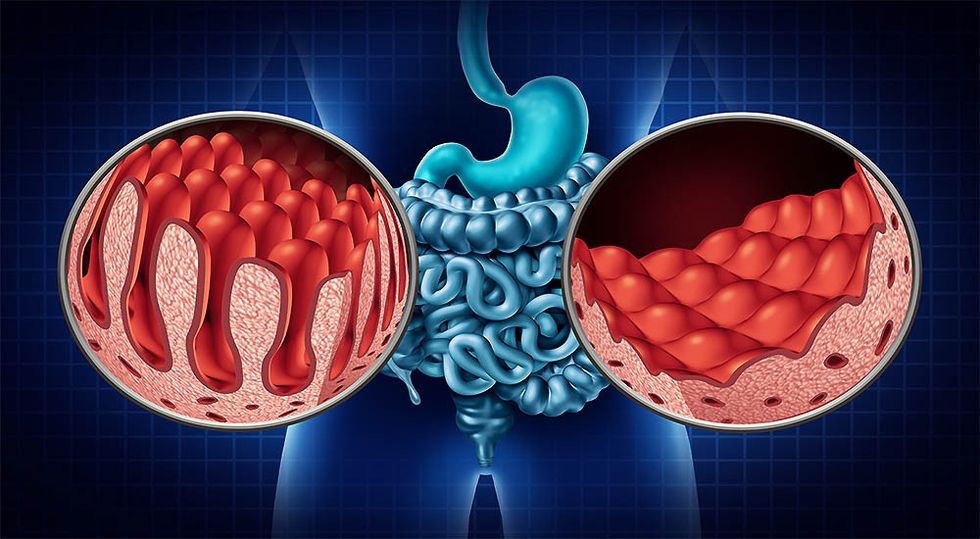 Celiac Disease and Gluten 6765