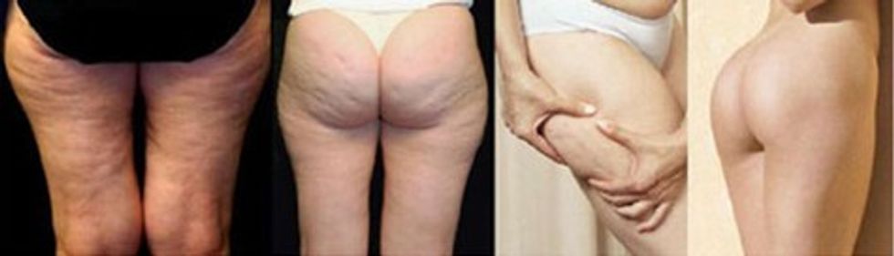 Cellulite before and after 1000