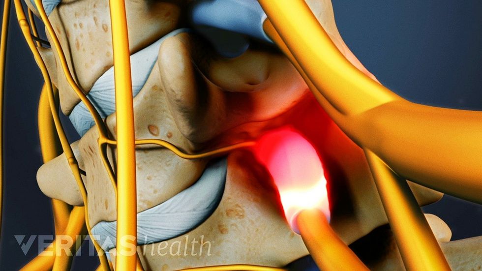 cervical spinal stenosis bone spurs