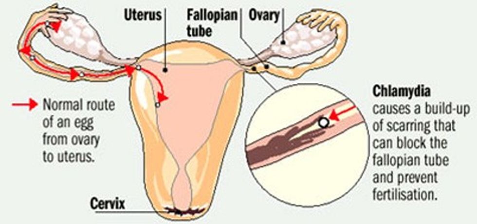 chlamydia fallopian tube(2)