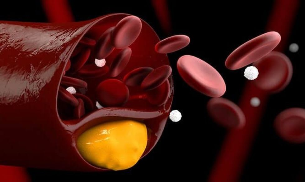 cholesterol atherosclerosis erectile dysfunction