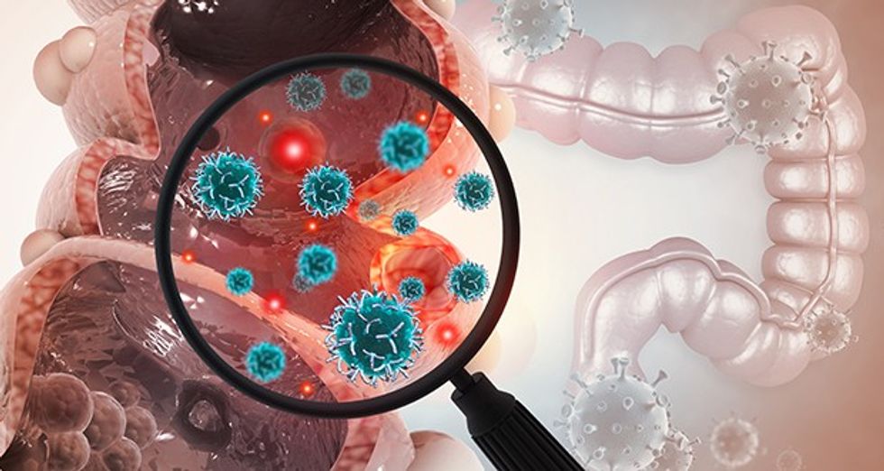 colorectal cancer GettyImages 1391424692 620