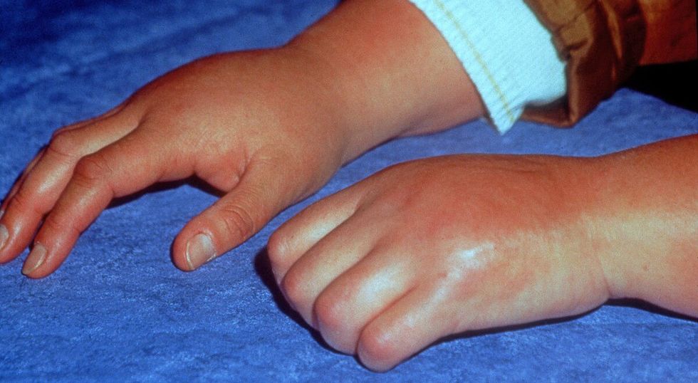 complex regional pain syndrome