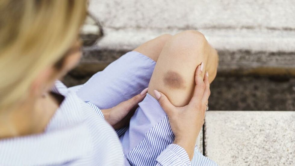 contusion GettyImages 149552