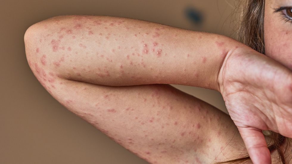cropped womans arm allergic rash 1337085512