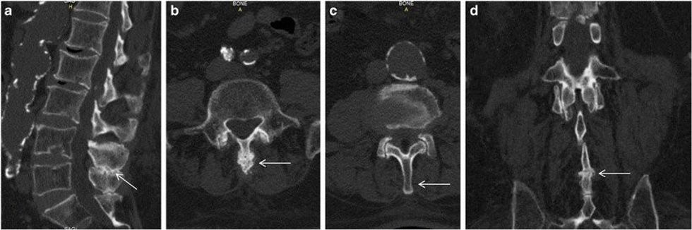 CT images a Sagittal reconstructi