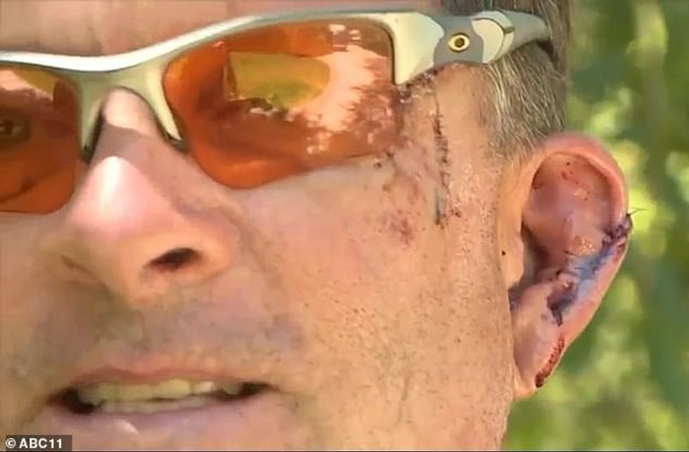 Cuts to Chernosky's ear and face are clearly visible after being attacked by a black bear